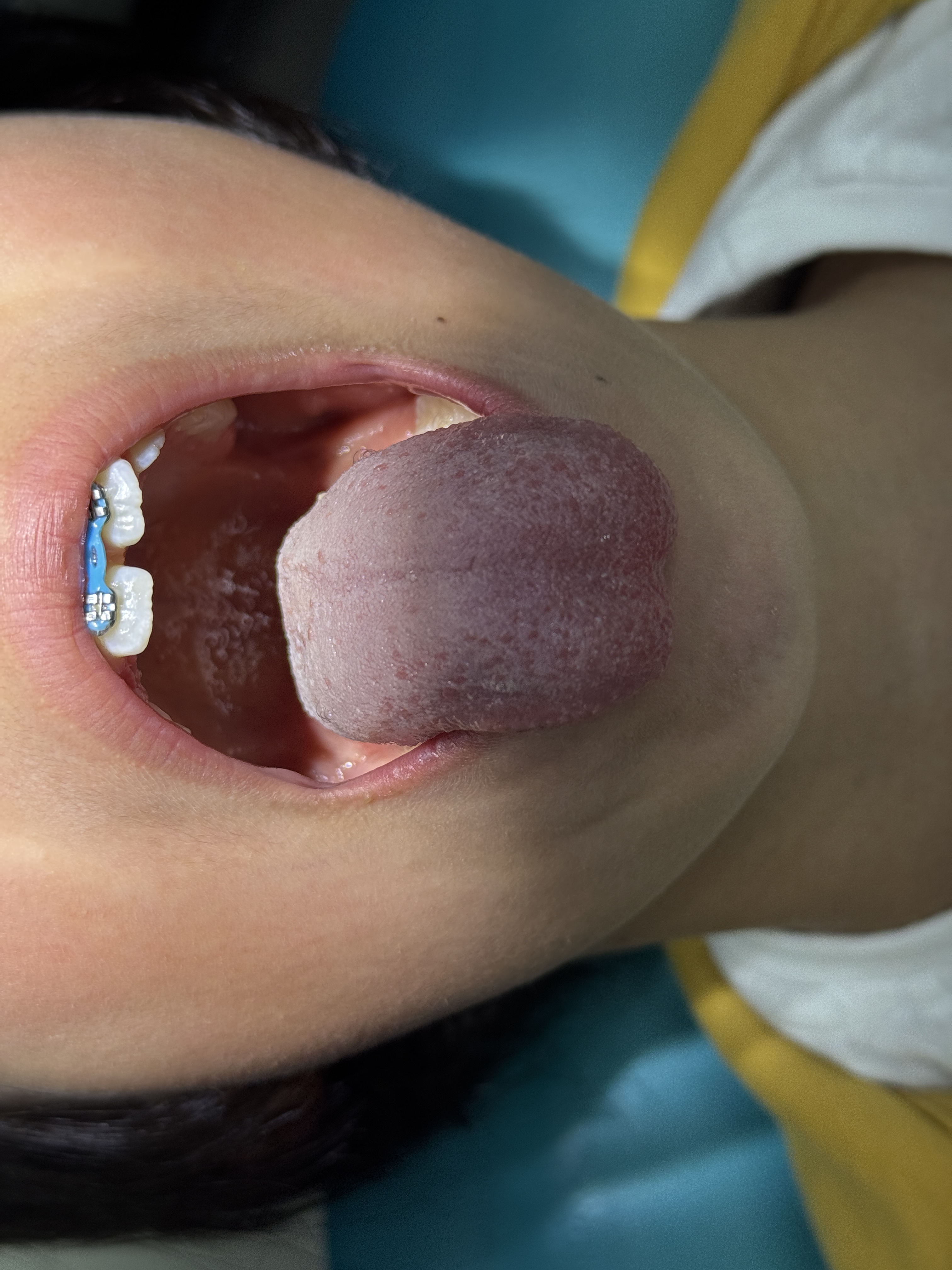 Después — frenectomía